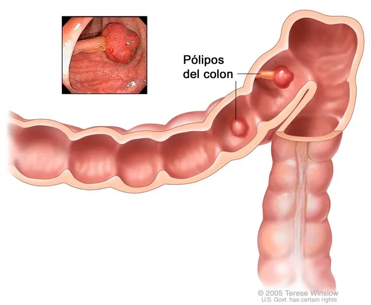 Pólipos en el colon