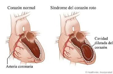 Síndrome de corazón roto