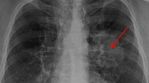 Cáncer de pulmón/P24