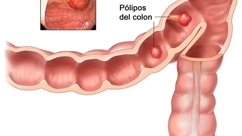 Pólipos en el colon