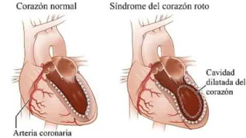 Síndrome de corazón roto