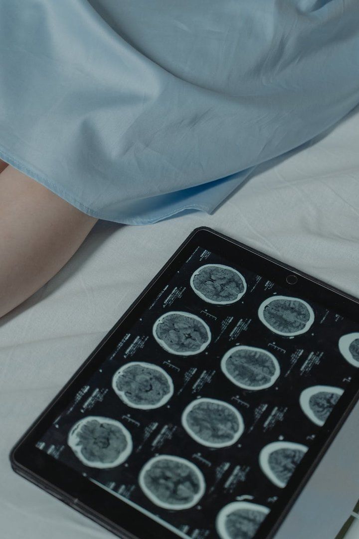 Descubrieron un feto gemelo no nacido en el cerebro de una niña