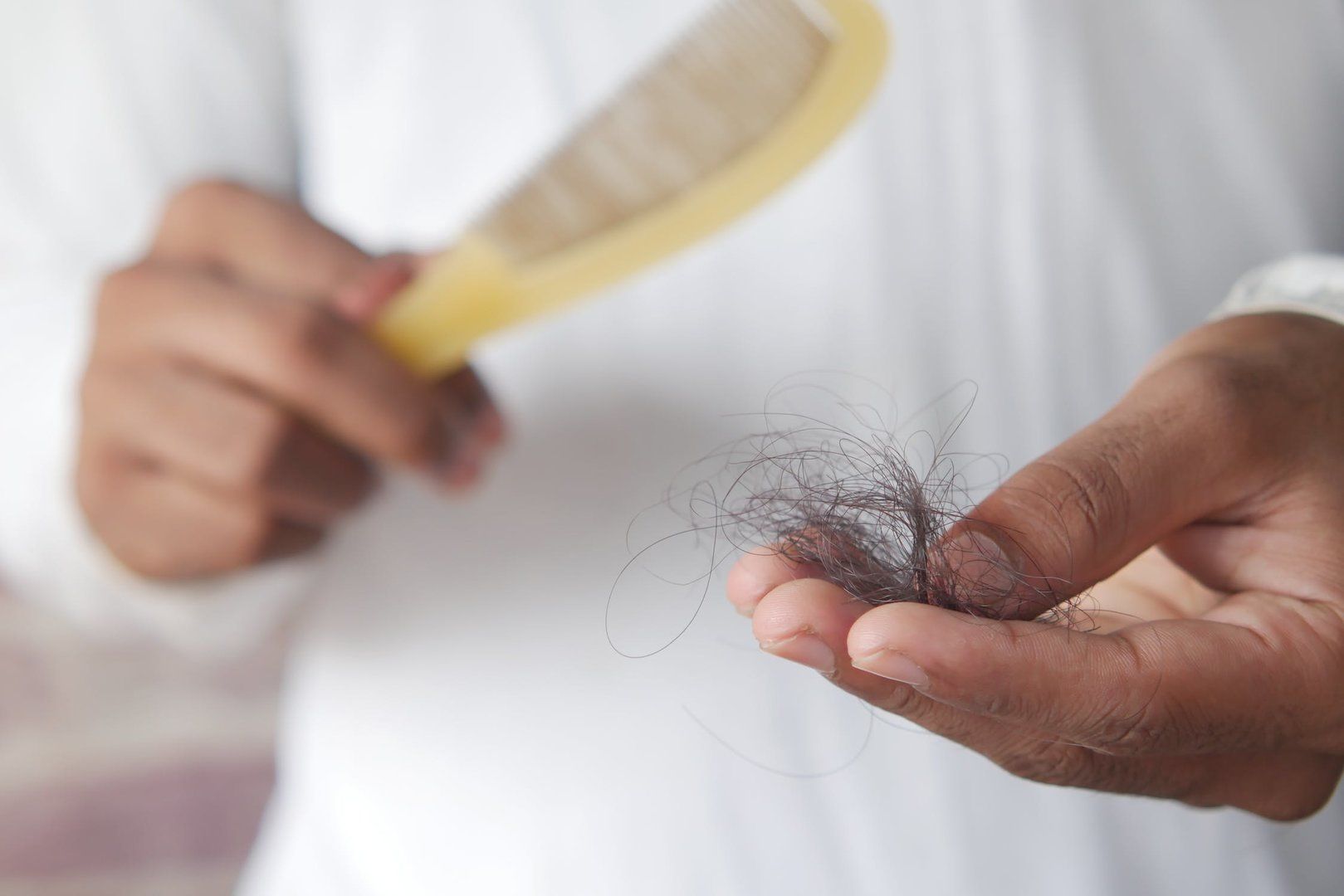 ¡Te Interesa! Lo que debes conocer sobre la alopecia
